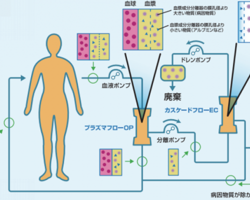 DFPP血液净化